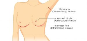 breast enlargement incision sites for breast implants
