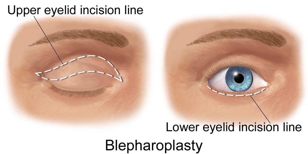 eye bag removal surgery london, kent, essec