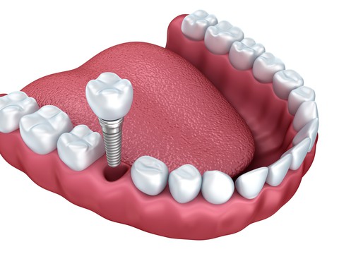 dental implant being inserted
