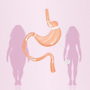 how des gastric banding work