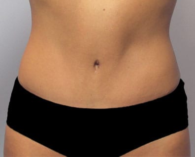 tummy tuck after