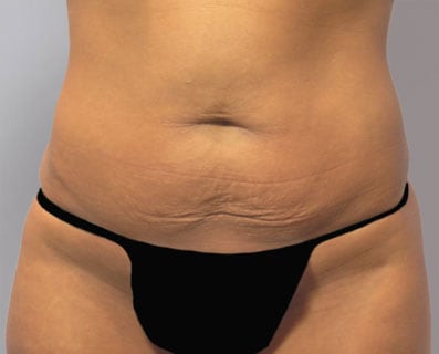 tummy tuck before