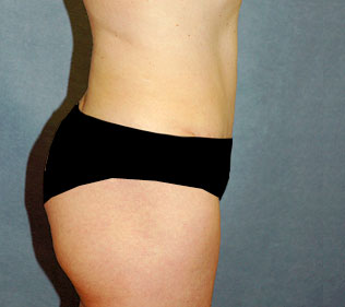 tummy tuck after