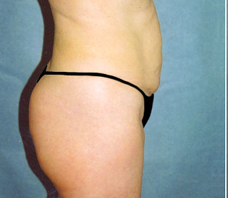 tummy tuck before