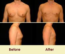 moobs gynecomastia before and after