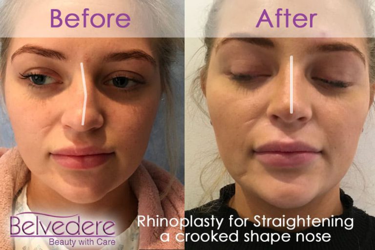 rhinoplasty before and after