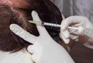 hair restoration injection for hair transplant
