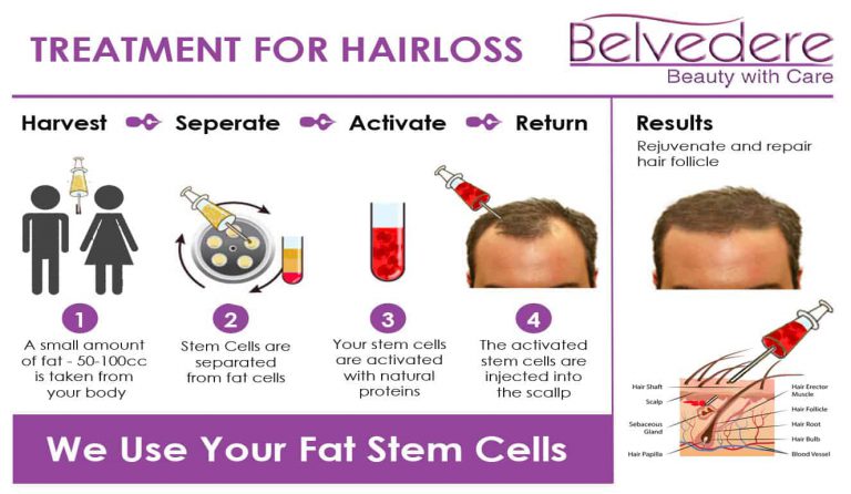 stem cell hair loss treatment